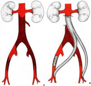 La figure A montre une occlusion de l’aorte sous les reins et des deux artères pour les membres inférieurs (artères iliaques). La figure B montre le traitement de ces lésions par un pontage aorto-bi fémoral (mise en place d’une prothèse entre l’aorte et les 2 artères fémorales (localisés au niveau des plis de l’aine).