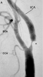 lesions de la carotide