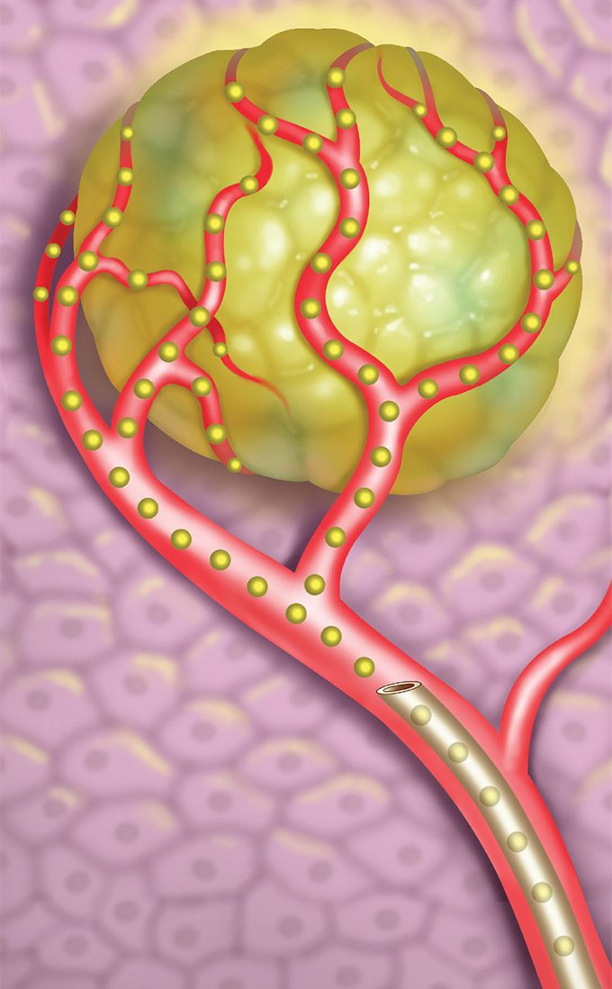 La radio-embolisation consiste en l’injection de billes radio-actives dans les tumeurs pour les détruire