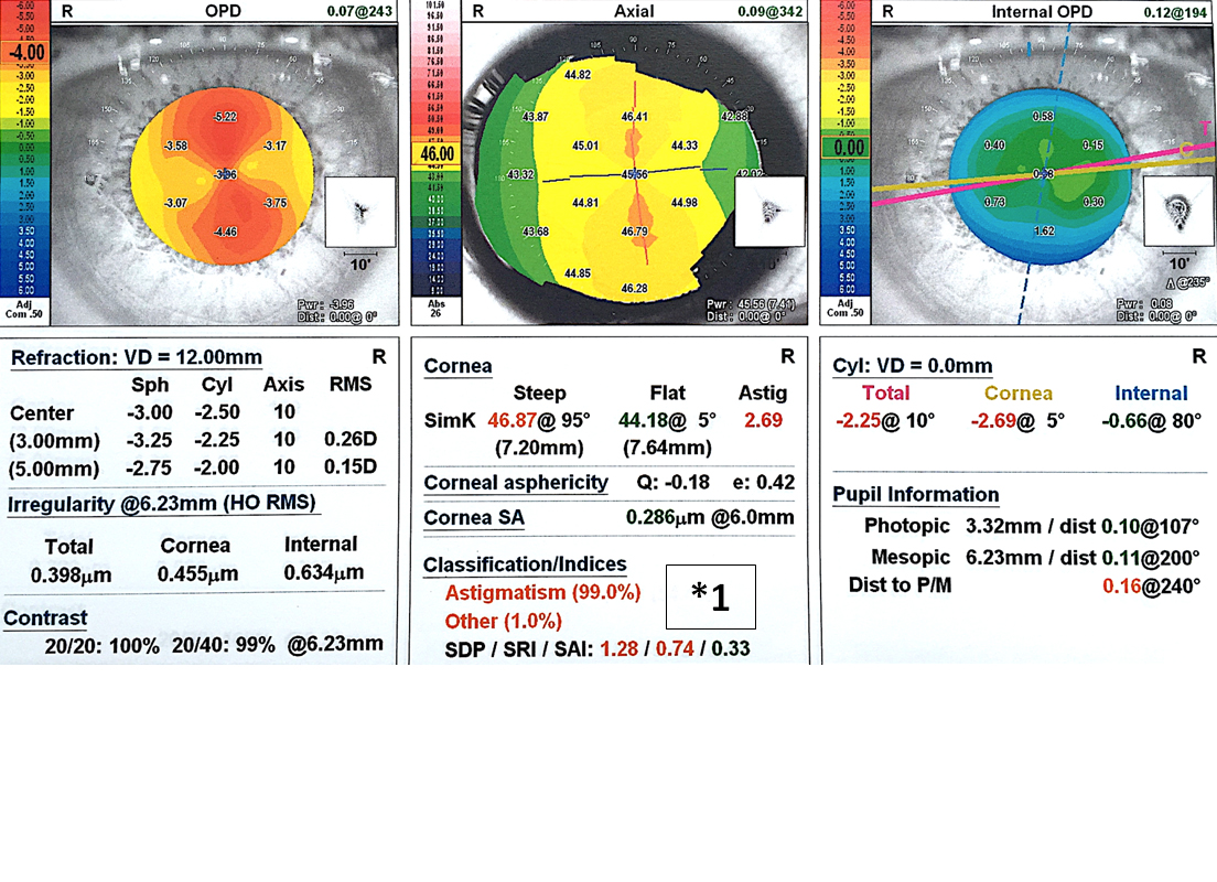 *1: Bilan anatomique par aberrométrie OPD-Scan III ® permettant un bilan approfondi de la cornée (réfraction objective, astigmatisme cornéen, aberrations optiques de haut degré, pupillométrie, indice de dépistage du kératocône). Le patient présente ici une myopie et un astigmatisme congénital sans argument en faveur d’une kératocône. C’est donc un bon candidat pour bénéficier d’une chirurgie réfractive par LASIK ou PKR