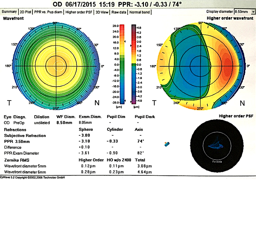 Bilan anatomique par l’aberromètre ZYWAVE® montrant la présence d’aberrations d’ordre supérieur et inférieur et permettant un bilan approfondi de la cornée (réfraction objective, aberrations optiques de bas et de haut degré, pupillométrie). En cas d’aberration optique d’ordre supérieur élevé, un traitement guidé par aberrométrie peut être proposé afin d’optimiser de façon personnalisée la qualité de la vision.