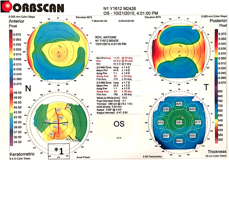 *1: Bilan anatomique par la topographie d’élévation ORBSCAN® montrant une asymétrie verticale de cambrure avec l’hémi-cornée inférieure plus cambrée. Le patient présente ici le diagnostic de kératocône frustre. Le diagnostic du kératocône fruste est une priorité en chirurgie réfractive, car le LASIK y est contre-indiqué, sous peine de risquer la survenue d’une ectasie cornéenne.