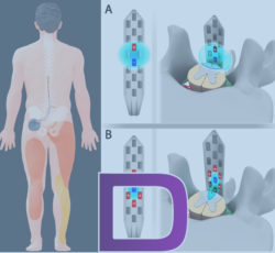 douleur neurostimulation