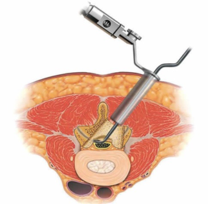 Exérèse hernie discale par voie mini-invasive