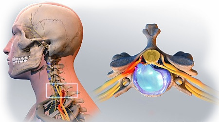 Hernie discale cervicale