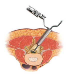 chirurgie hernie discale lombaire