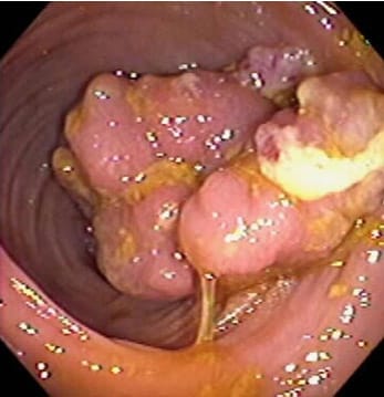 Diagnostic de cancer du colon en coloscopie