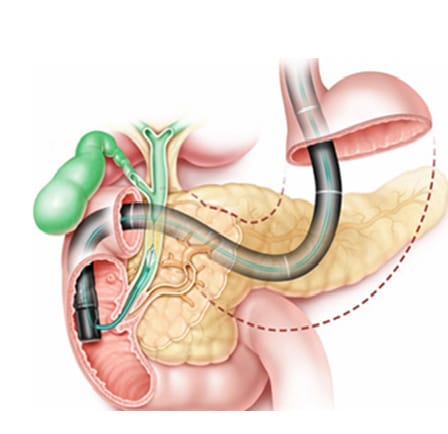 Cholangio-pancréatoscopie 