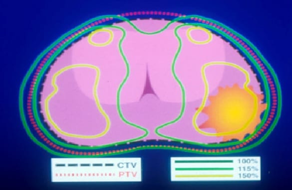 Curiethérapie cancer de la prostate bis