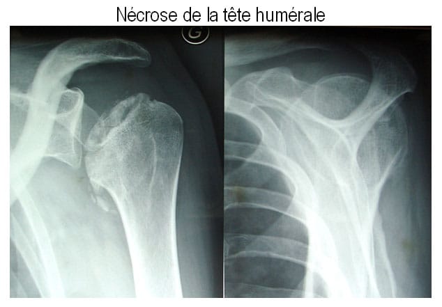 Nécrose de la tête humérale