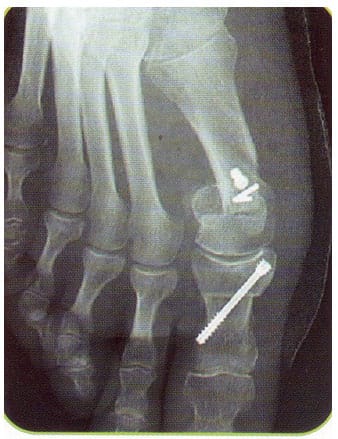 Déformation du gros orteil (hallux-valgus). Opérée par voie mini-invasive de 3 cm. Récupération fonctionnelle plus rapide.