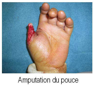 Pouce amputé